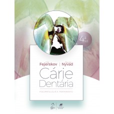 Cárie Dentária: Fisiopatologia E Tratamento