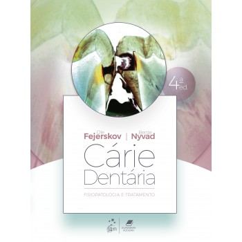 Cárie Dentária: Fisiopatologia E Tratamento