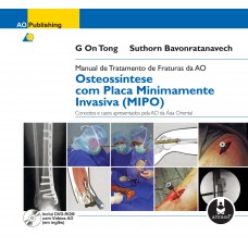 Manual De Tratamento De Fraturas Da Ao: Osteossíntese Com Placa Minimamente Invasiva (mipo)