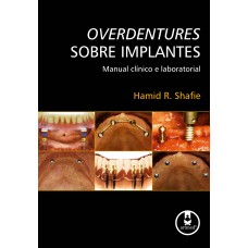 Overdentures Sobre Implantes: Manual Clínico E Laboratorial