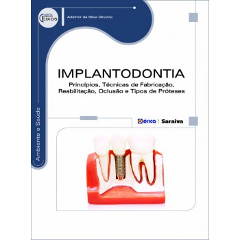 Implantodontia: Princípios, Técnicas De Fabricação, Reabilitação, Oclusão E Tipos De Próteses