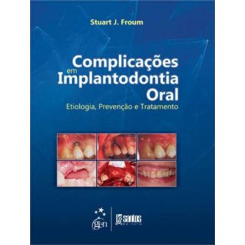 Complicações Em Implantodontia Oral - Etiologia, Prevenção E Tratamento