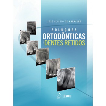 Soluções Ortodônticas para Dentes Retidos