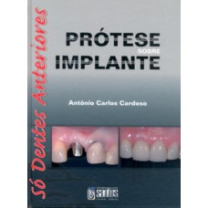 Prótese Sobre Implante - Só Dentes Anteriores