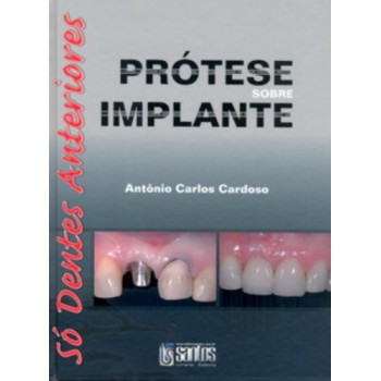 Prótese Sobre Implante - Só Dentes Anteriores