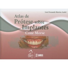 Atlas de Prótese sobre Implantes Cone Morse