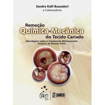 Remoção Química E Mecânica Do Tecido Cariado