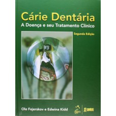 Cárie Dentária